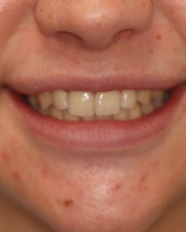 Composite bonding: before treatment, featured by Cedars Dental