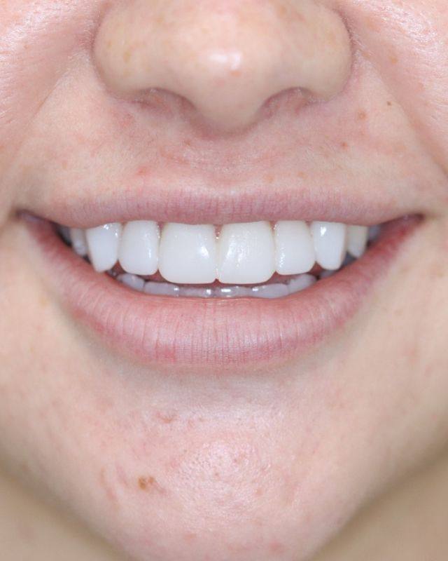 Composite bonding: after treatment, featured by Cedars Dental